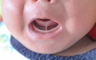 Lip & Tongue Ties: Why Early Evaluation Can Make a Big Difference