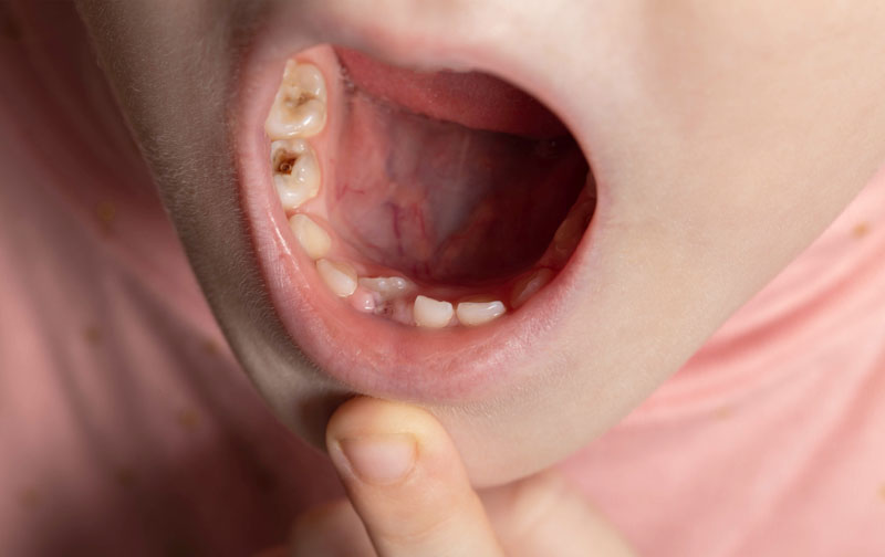 The child has a wrong tooth. Eruption of a permanent tooth in children, close-up
